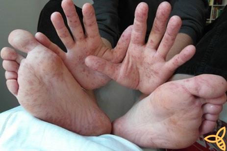 A kéz-láb-száj betegség